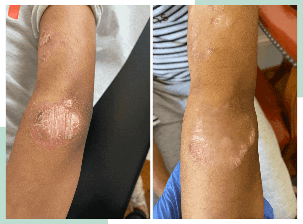 dr-ana-eczema-transformations-3--1-